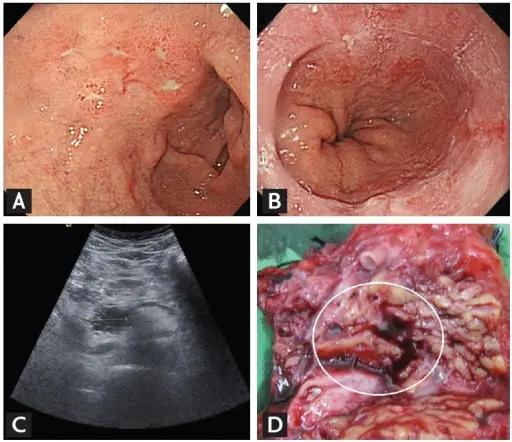 Zollinger-Ellison Syndrome