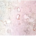 Chronic Antibody Mediated Rejection