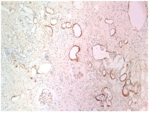 Chronic Antibody Mediated Rejection