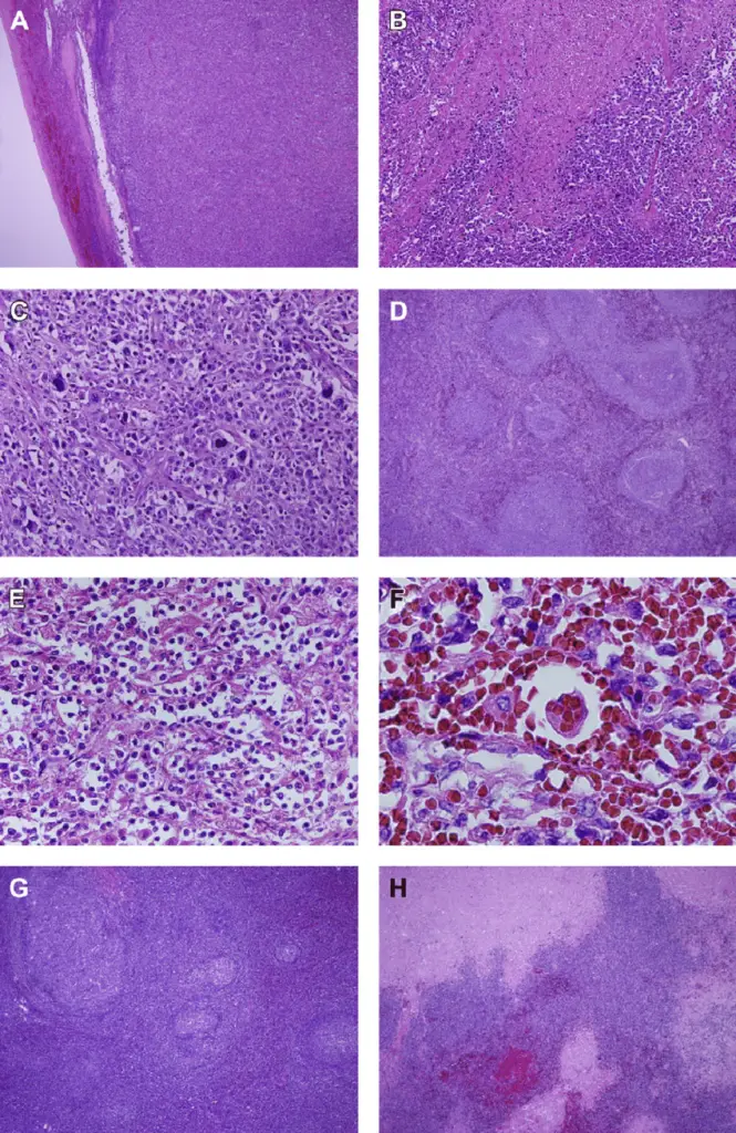 splenic lymphoma