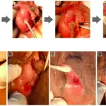 Bartholin Cyst