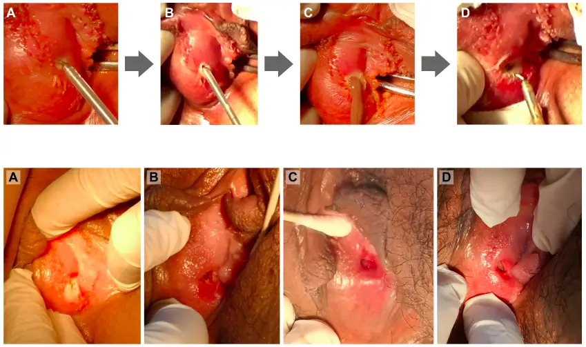 Bartholin Cyst