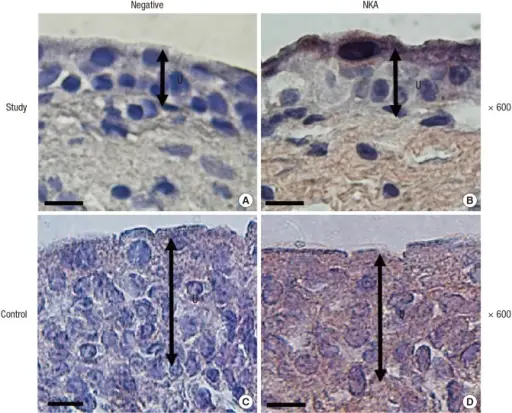 Interstitial Cystitis