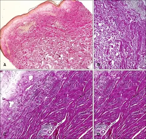 Lichen Sclerosus