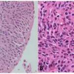 Papillary Urothelial Neoplasm of Low Malignant Potential
