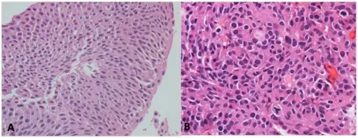 Papillary Urothelial Neoplasm of Low Malignant Potential