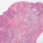 Vulvar Carcinoma