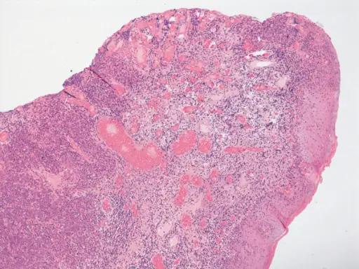 Vulvar Carcinoma