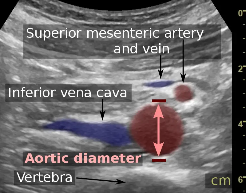 Abdominal Aortic Aneurysm