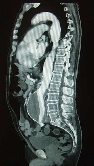 Abdominal Aortic Aneurysm