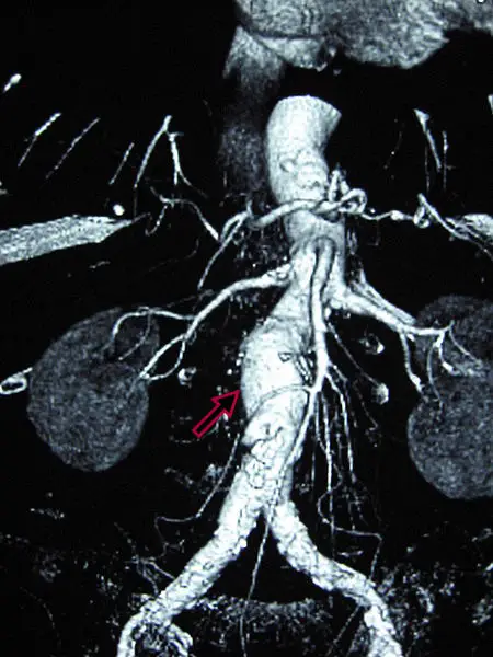 Abdominal Aortic Aneurysm