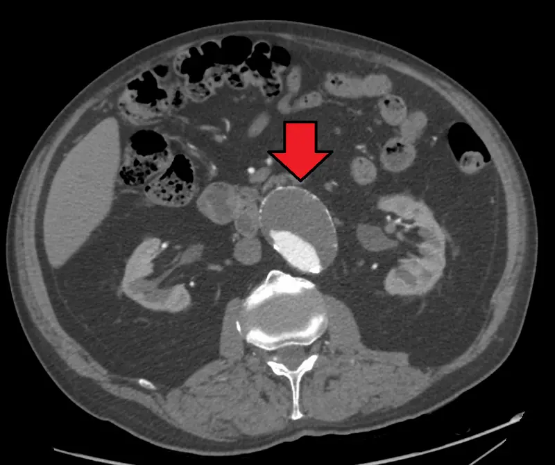 Abdominal Aortic Aneurysm