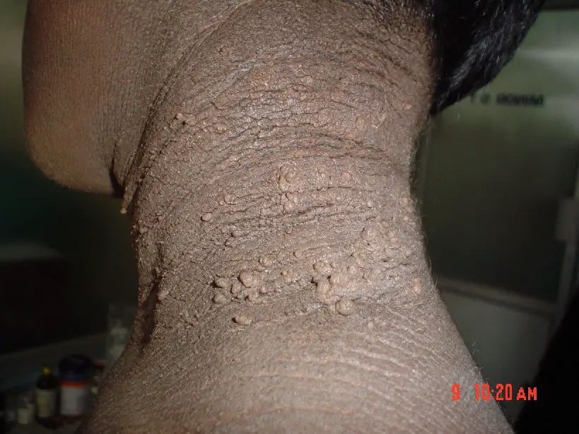 Acanthosis Nigricans