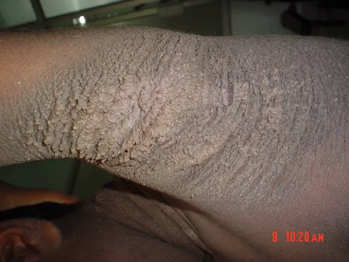 Acanthosis Nigricans