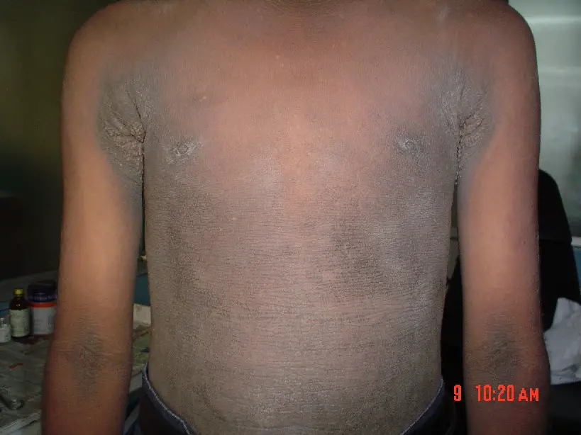 Acanthosis Nigricans