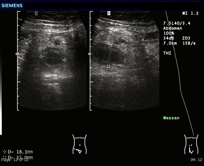 Acute Appendicitis