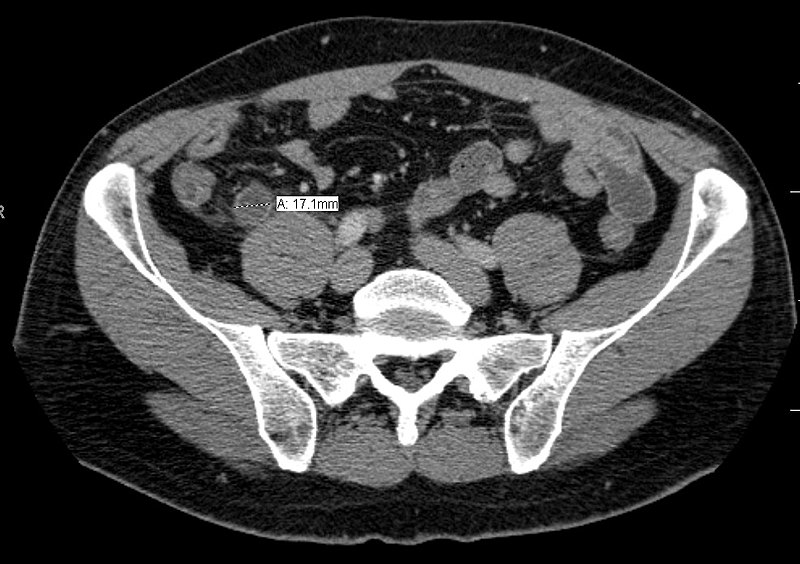 Acute Appendicitis