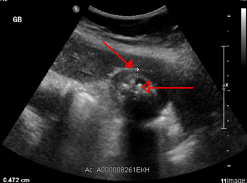 Acute Cholecystitis