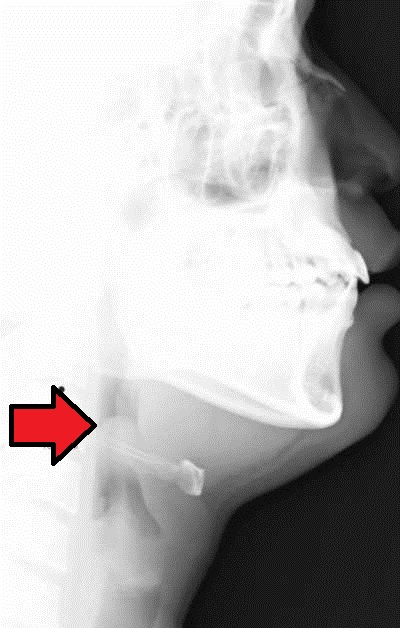 Acute Epiglottitis