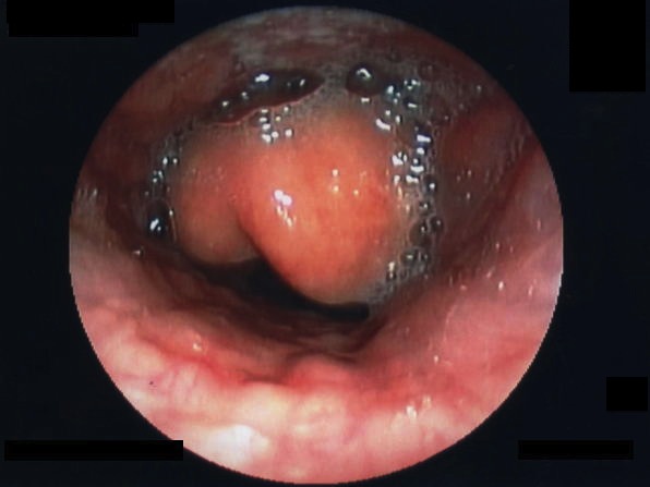 Acute Epiglottitis