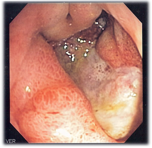 Acute Gastritis