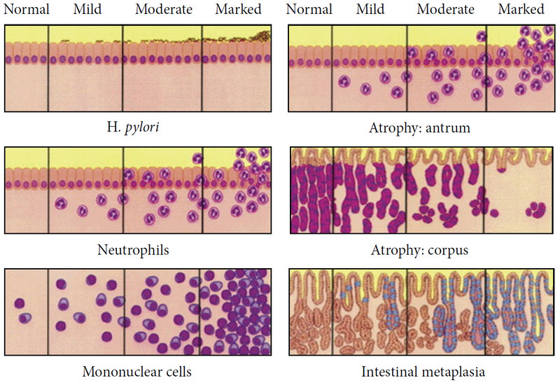 Acute Gastritis