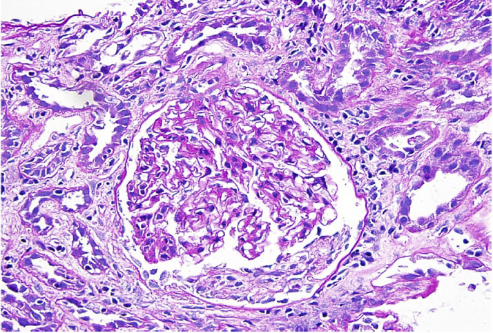 Acute Interstitial Nephritis