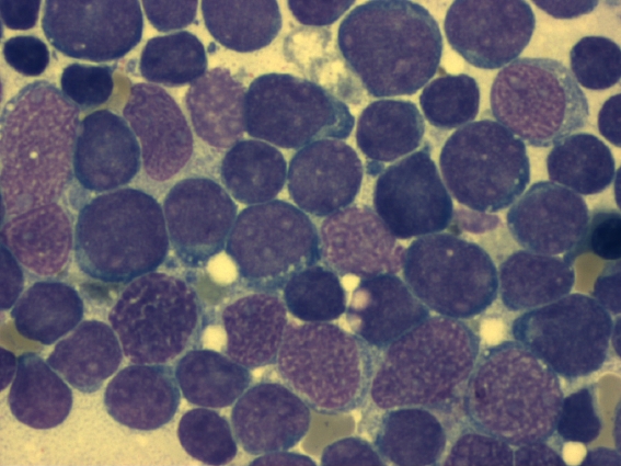 Acute Lymphoblastic Leukemia
