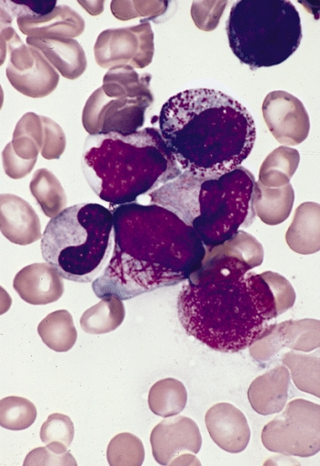 Acute Promyelocytic Leukemia