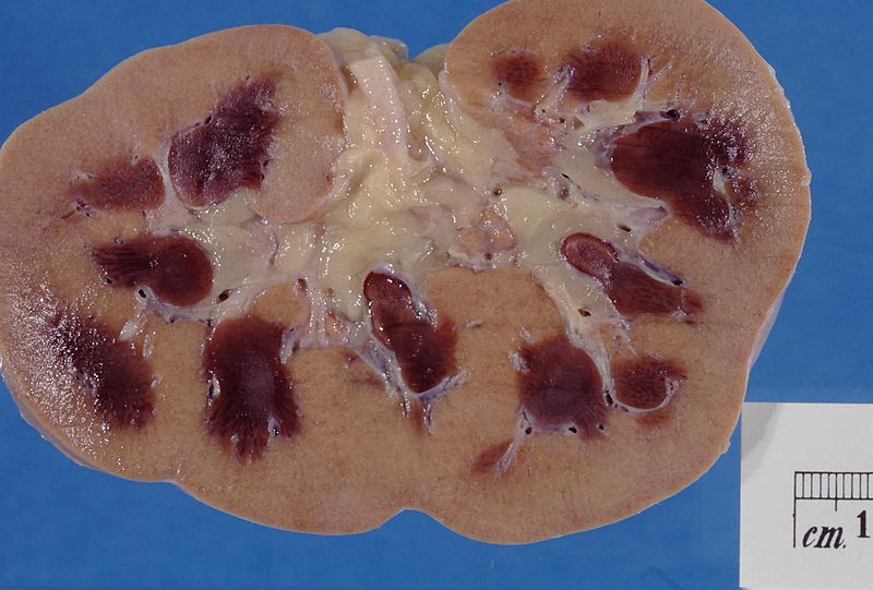 Acute Renal Failure