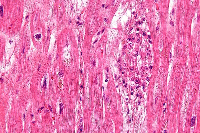 Acute Rheumatic Fever