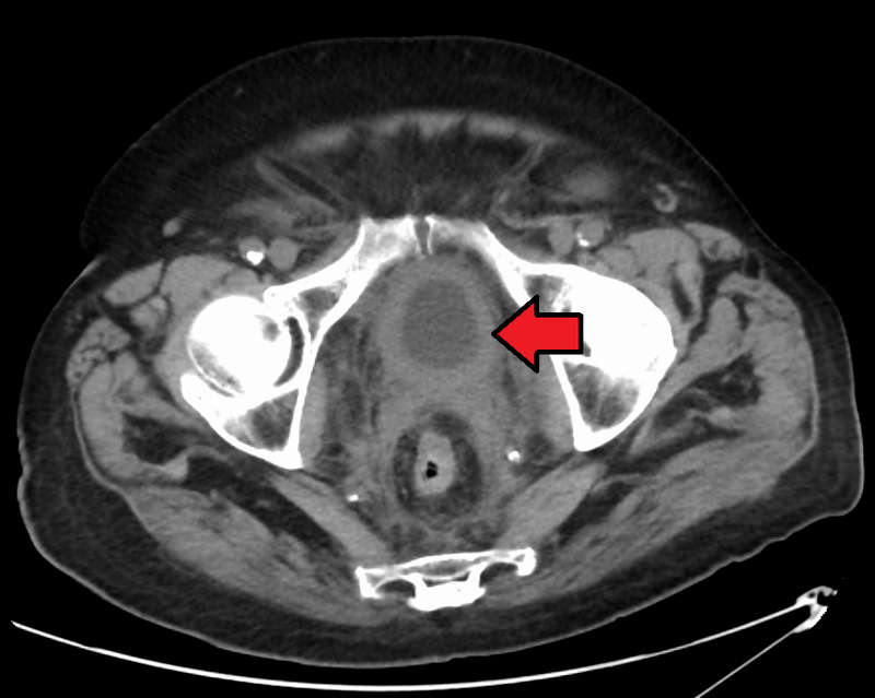 Adenocarcinoma of the Bladder