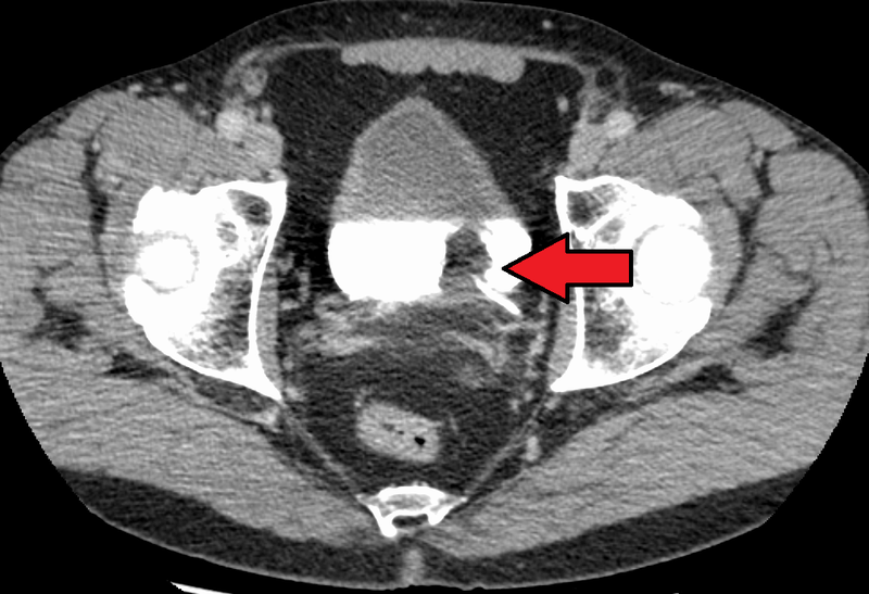 Adenocarcinoma of the Bladder