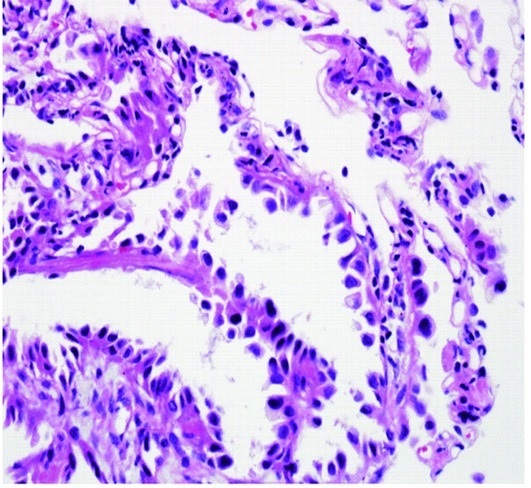 Adenocarcinoma of the Lung