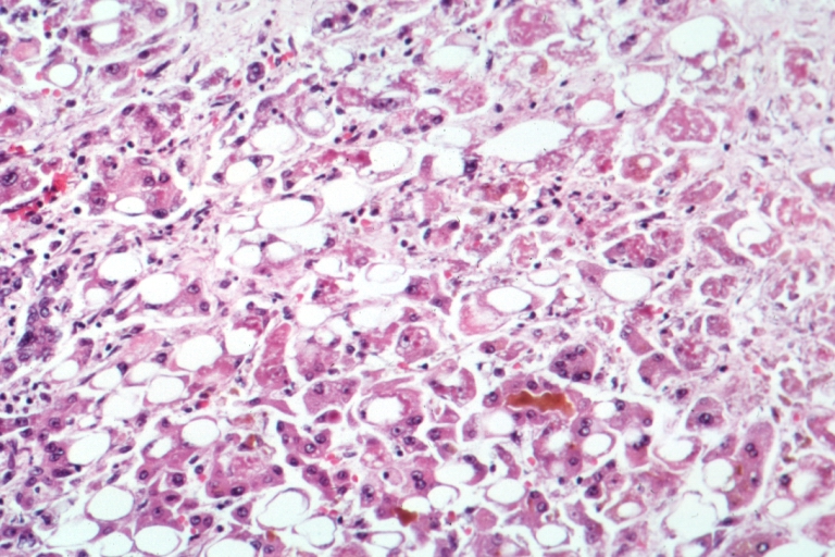 Alcohol Related Liver Disease