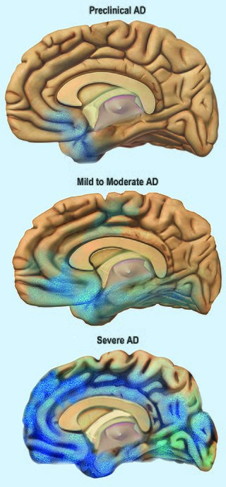 Alzheimer Disease (AD)