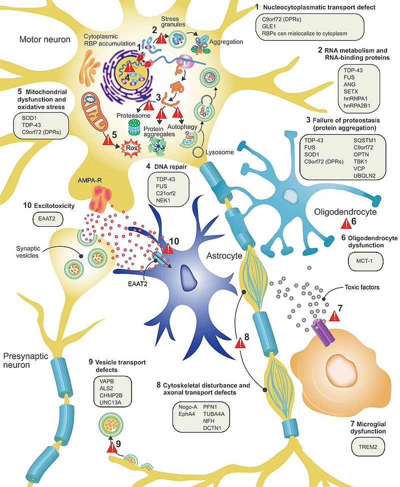 Amytrophic Lateral Sclerosis