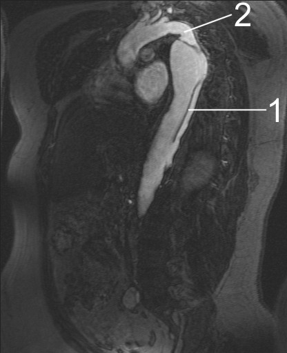 Aortic Dissection