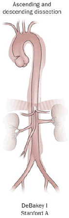 Aortic Dissection