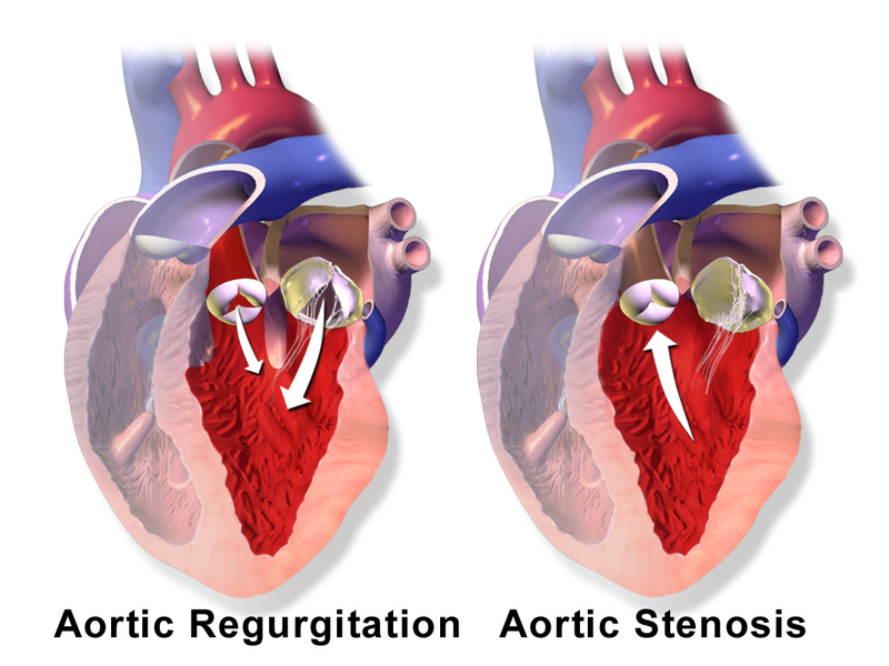 Aortic regurgitation