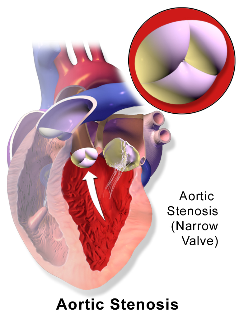 Aortic stenosis