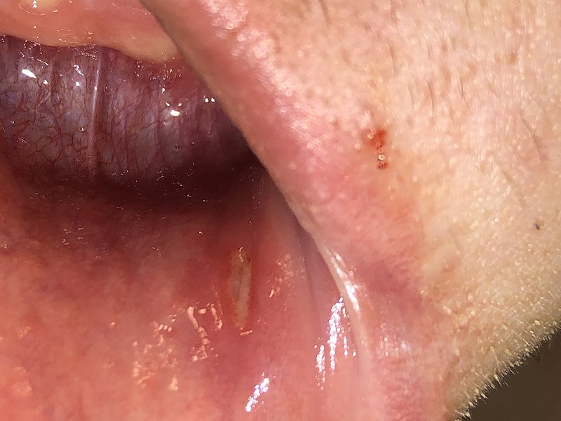 Aphthous Ulcer