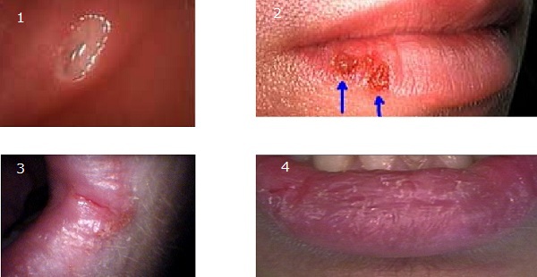 Aphthous Ulcer
