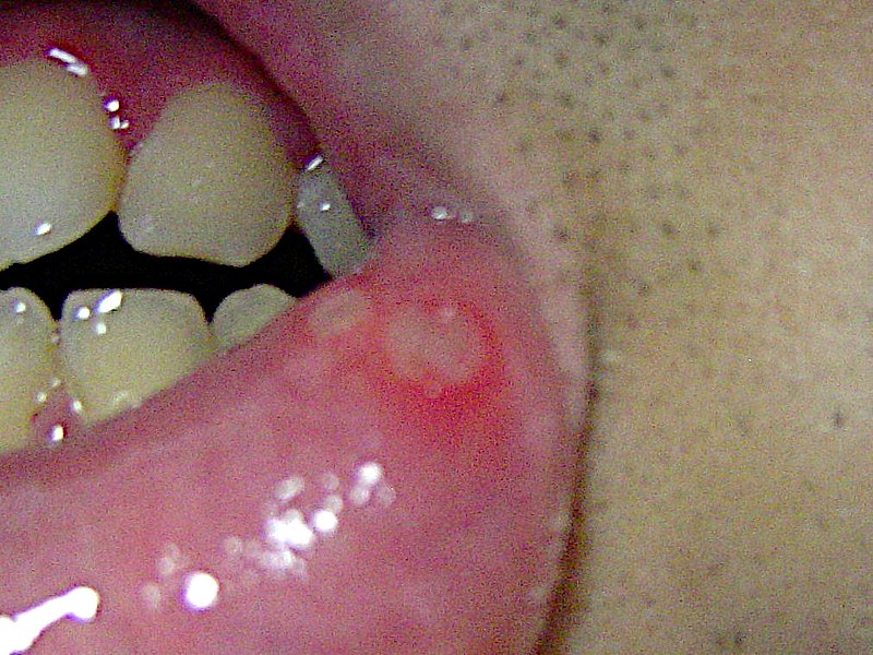 Aphthous ulcer