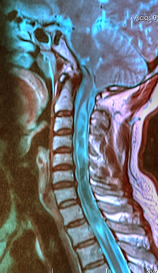 Arnold Chiari Malformation