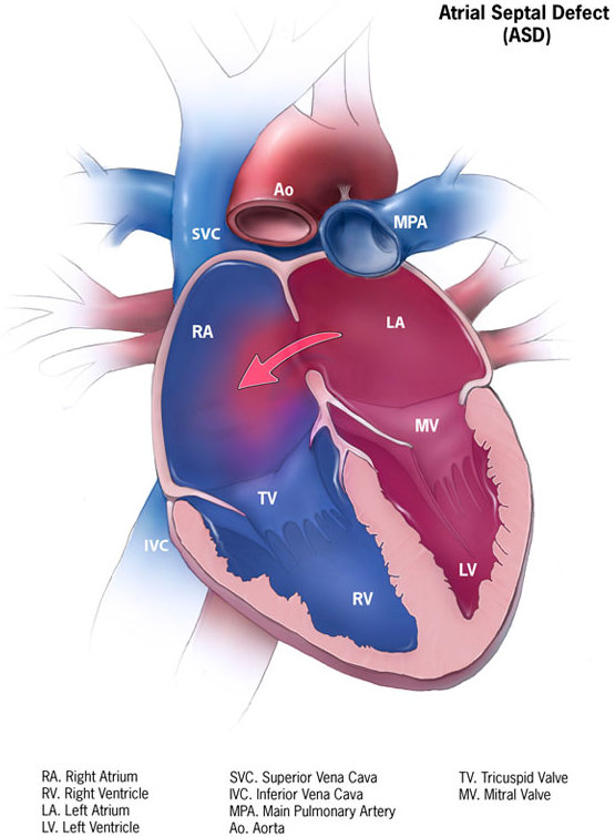 Atrial Septal Defect (ASD)