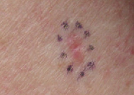 Basal Cell Carcinoma