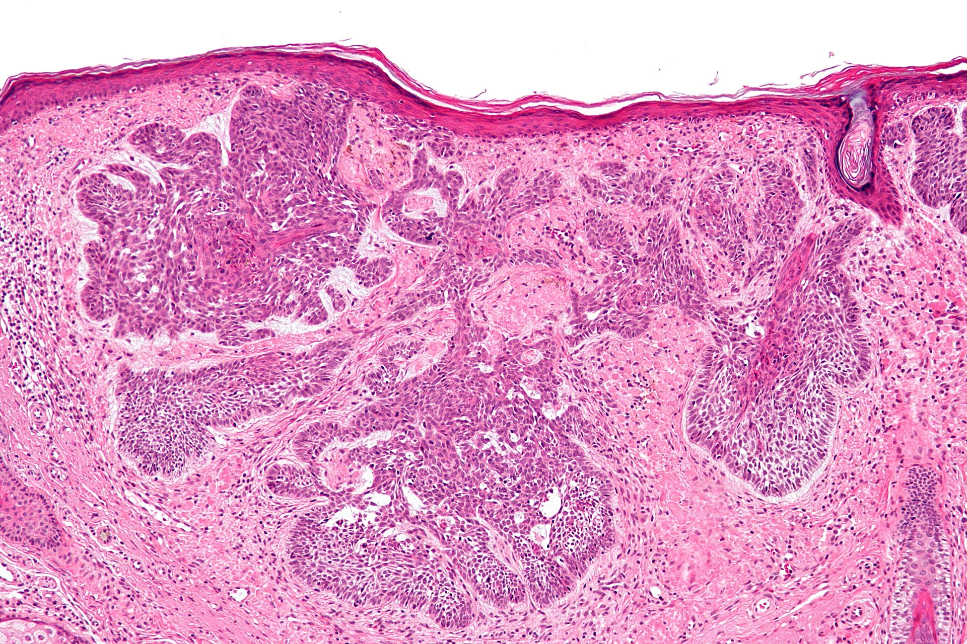 Basal Cell Carcinoma