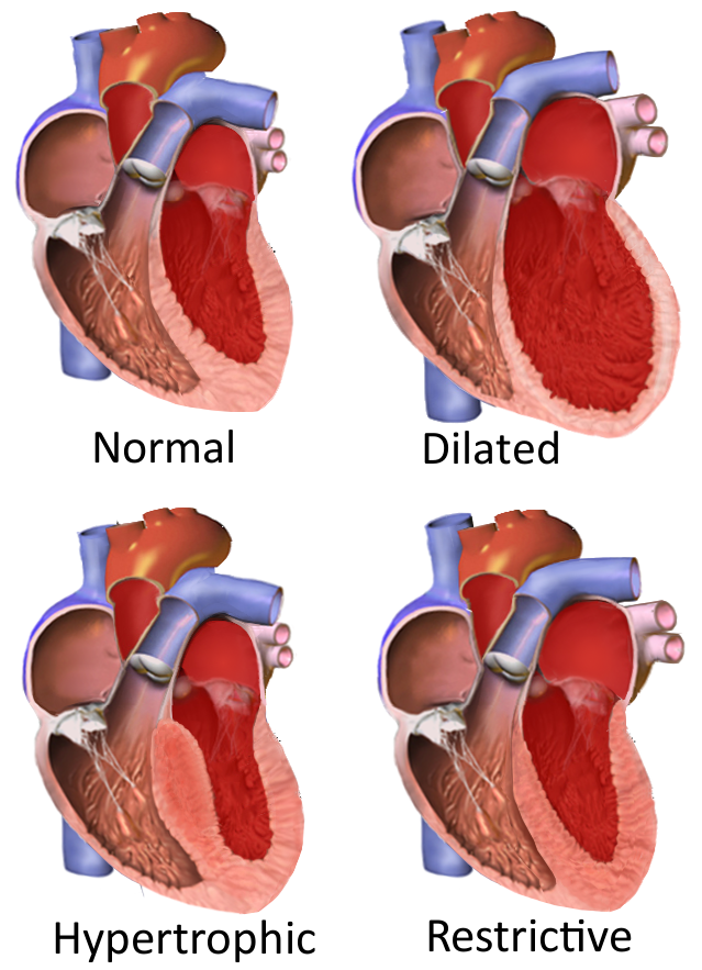 Cardiomyopathy