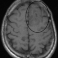 Oligodendroglioma